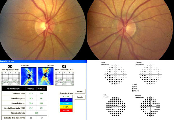 diagnostico de glaucoma